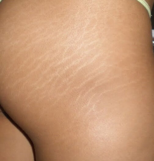 Groeistrepen op de benen