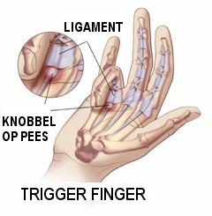 Haperende vinger