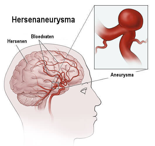 Hersenaneurysma