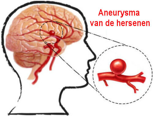 Hersenaneurysma: wat is het en hoe voorkom je het