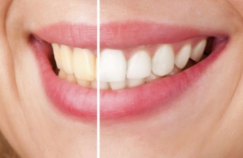 Hoe maak je op een natuurlijke wijze je tanden witter?
