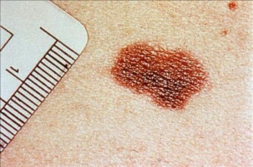 Ontcijfer de berichten van je huid door bijvoorbeeld op de kleur te letten