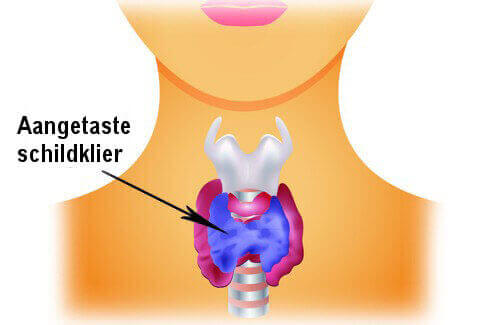 tekening aangetaste schildklier