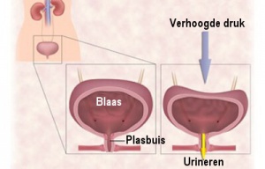 10 natuurlijke behandelingen voor een overactieve blaas