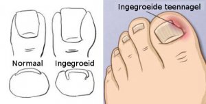 Behandelingen voor ingegroeide teennagels