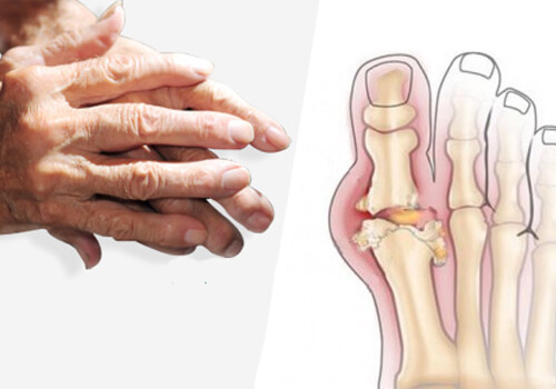 Aanbevelingen om artritis te behandelen