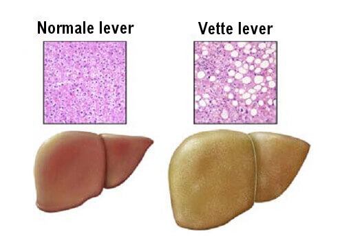 Eigenschappen van een vette lever