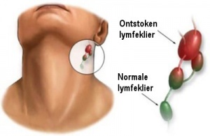 Wat veroorzaakt ontstoken lymfeklieren?