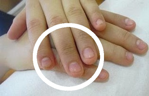 Tips om te stoppen met nagelbijten