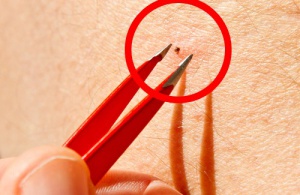 Teken: een gevaar voor zowel dieren als mensen