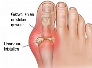 De gevaren van te veel urinezuur