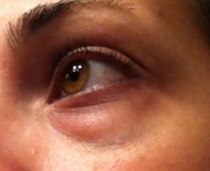 Wallen verminderen op een natuurlijke manier