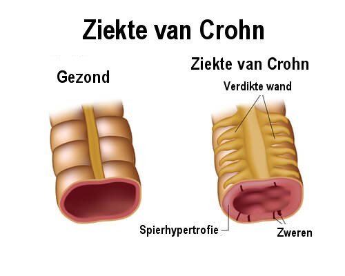 Wat is de ziekte van Crohn? - Gezonder Leven