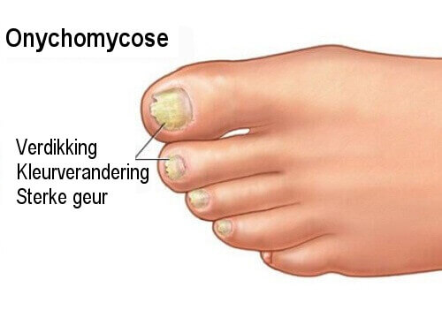 Onychomycose: een nagelschimmel