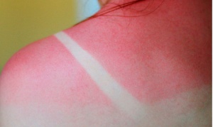 De beste middelen tegen zonnebrand