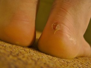 Genees blaren snel met natuurlijke remedies