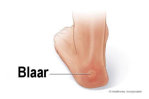 Genees blaren snel met natuurlijke remedies