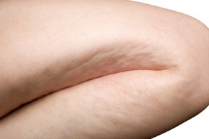 Natuurlijke tips en behandelingen voor cellulite