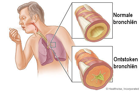 chronische-bronchitis