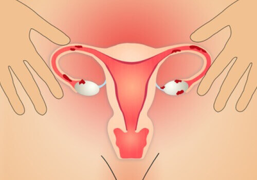 Endometriose behandelen met voeding