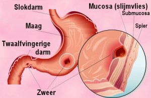 Maagzweren natuurlijk behandelen