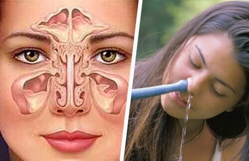 Simpele en natuurlijke manieren om sinusitis te behandelen