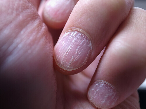 Schimmel op de Nagels