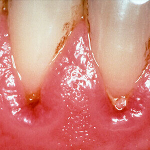 Wat is tandvleesontsteking en hoe wordt het veroorzaakt