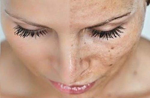 Veroudering van de huid