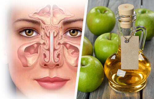Gebruik van appelazijn bij een bijholteontsteking