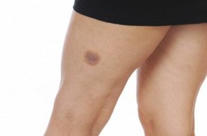 Zo genees je snel blauwe plekken