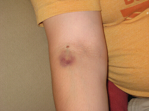 Blauwe Plek op de Arm