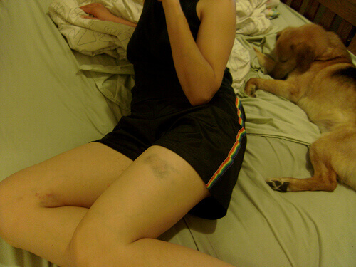 Blauwe Plek op het Been