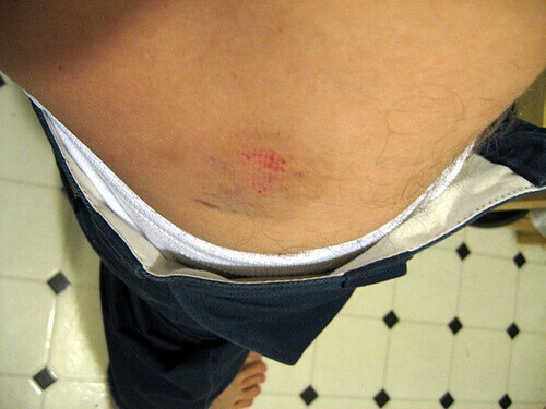 Blauwe Plek in de Zij