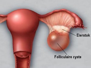 Cystes op de eierstokken ontdekken en voorkomen
