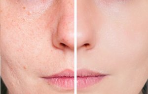 Natuurlijke remedies tegen acnelittekens