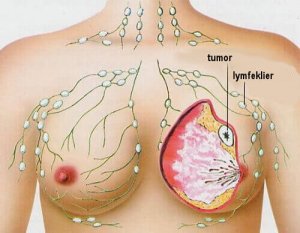 De 5 meest voorkomende types kanker bij vrouwen