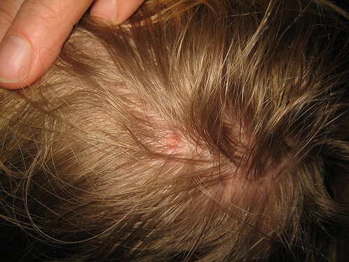 Hoe luizen op een natuurlijke manier verwijderen?