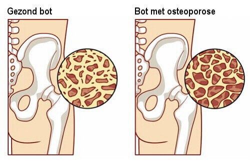 8 voedingsmiddelen helpen osteoporose tegen te gaan