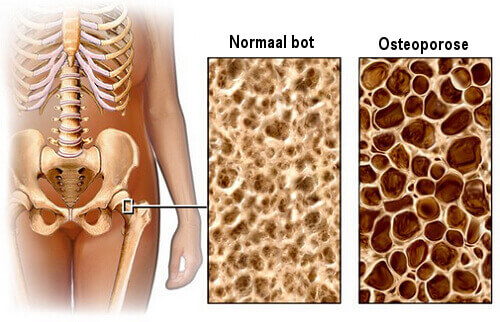 Voedingstips tegen osteoporose