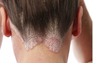 Huismiddeltjes tegen roos en seborroïsch eczeem