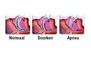 Zo kun je op natuurlijke wijze stoppen met snurken