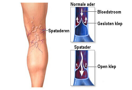Tips om pijn van spataderen te verlichten - Gezonder Leven