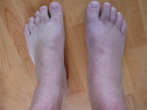 Remedies met zuiveringszout tegen jicht