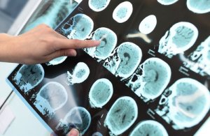 Kan je Alzheimer voorkomen?