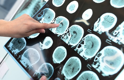 Kan je Alzheimer voorkomen?