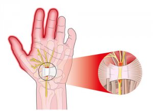 5 tips om pijn van carpaletunnelsyndroom te verlichten