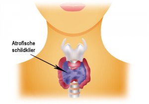 Hypothyreoïdie: zorgen voor je schildklier
