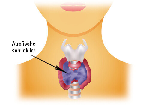 Atrofische Schildklier