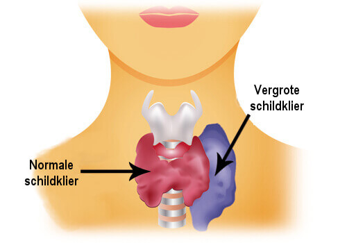 Vergrote schildklier